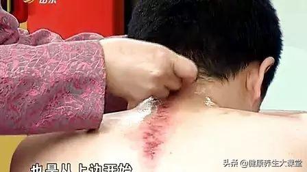 刮痧后運動(dòng)可以嗎_刮痧后多久可以運動(dòng)_運動(dòng)刮痧可以后天天刮嗎